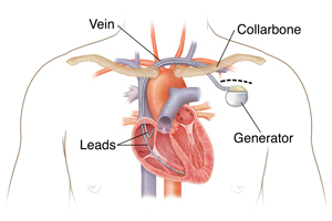 Outline of man's chest showing implantable cardioverter defibrillator in chest with leads going into heart chambers.