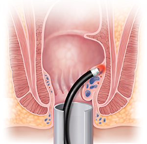 Cross section of anus showing laser treating hemorrhoid.