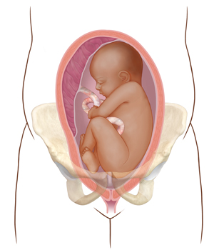 Front view cross section of uterus in pelvic bones showing fetus with head up, in wrong position for birth.