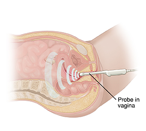 Cross section of female pelvis viewed from the side. Ultrasound transducer in vagina.