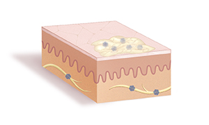 Section of skin showing crusted-over sore on surface with herpes viruses inside.