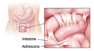 Outline of body showing stomach and intestines. Inset shows adhesions.