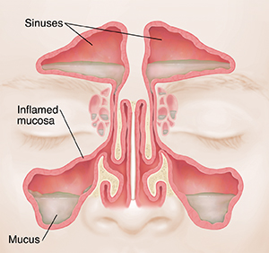 Front view of sinuses showing red, swollen lining and mucus.