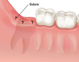 Closeup of gum and molars showing sutures closing gum where wisdom tooth was removed.