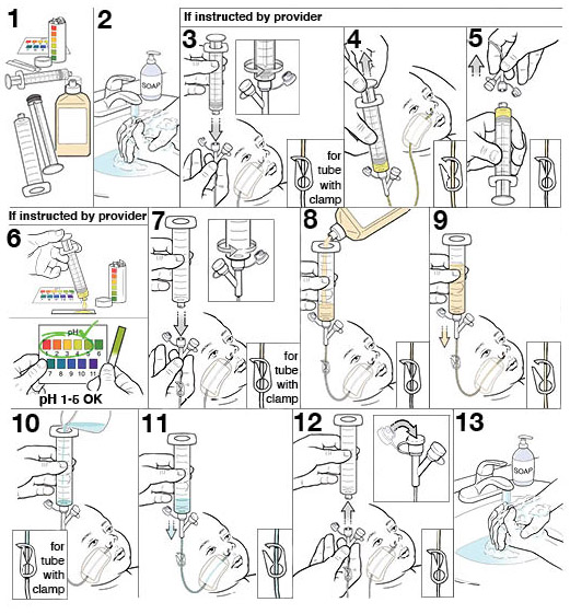 13 steps for using an NG tube to feed your baby