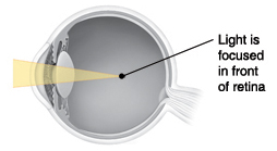 Cross section of eye showing light focusing in front of retina.