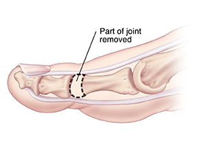 Side view of toe showing bone removed for arthroplasty.