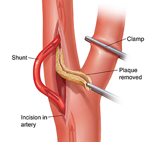 Carotid artery showing incision with instrument removing plaque and shunt rerouting blood flow.