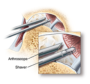 Cross section of hip joint with femoral head moved out of socket. Cartilage lining socket is damaged. Synovium lining joint is inflamed. Arthroscopic instruments are in joint near top of socket. Closeup of arthroscope tip inside joint with shaver removing damaged synovium.