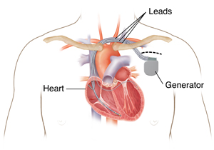 Outline of man's chest showing showing biventricular pacemaker ICD in chest with three leads going into heart chambers.