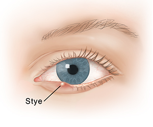 Front view of eye showing a stye on the bottom eyelid.