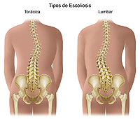 Ilustración que muestra una escoliosis lumbar