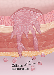 Corte transversal de la pared de la vejiga donde puede verse cáncer en etapa de metástasis.