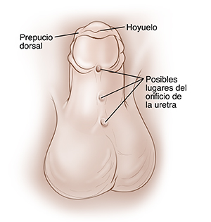 Pene de un niño apuntando hacia arriba para que se vea la parte inferior. El prepucio que rodea el glande está encapuchado y cuelga sobre la punta del pene. Hoyuelo en la punta del pene. Hay tres orificios por la parte inferior del pene en el centro desde el glande hasta el escroto que muestran los lugares posibles de la abertura para la uretra.