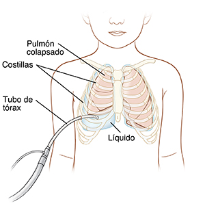 Contorno de un niño en el que pueden verse los pulmones y un tubo en el pecho para drenar líquido.