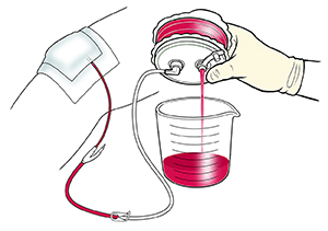 Closeup of gloved hand emptying fluid from hemovac drain into measuring container.