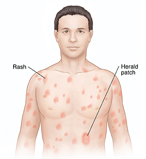 Front view of man's head and chest showing pityriasis rosea.