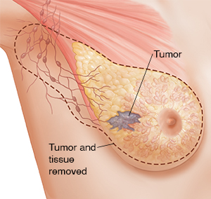 Three-quarter view of female underarm area showing breast anatomy ghosted in. Dotted line shows tissue and lymph nodes removed in modified radical mastectomy.